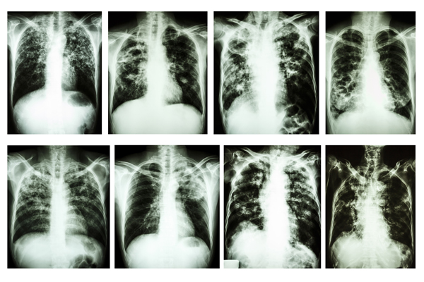 Tuberculosis